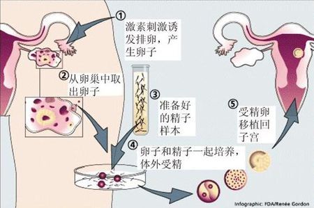 试管代怀生子助孕代妈